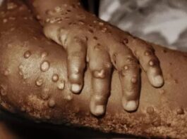 WHO Declares Mpox Outbreak in Africa a Public Health Emergency